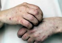 Llega el sarampión a los 32 estados; van 7 mil 131 contagios y 24 defunciones: Ssa