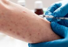 Confirma Ssa 10 mil 634 casos de sarampión; se triplicaron en este mes