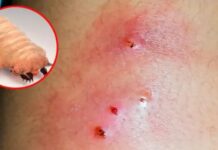 Reportan 5 casos más de personas con miasis por el gusano barrenador; suman 117 los humanos infectados