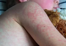 Confirma Ssa 9 mil casos de sarampión y 29 decesos